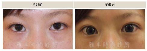 雅丰診所　超放電雙眼皮手術，自然美麗渾然成形