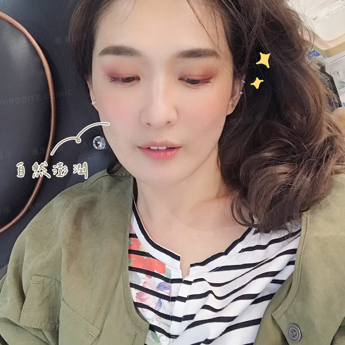 眼袋手術 抽脂補臉 雅丰診所案例小思 眼袋抽脂補臉術後照分享二