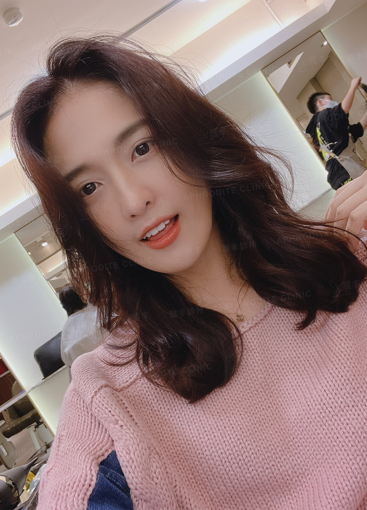 眼袋手術 抽脂補臉 雅丰診所案例小思 眼袋抽脂補臉術後照分享一