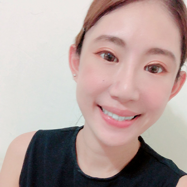 玻尿酸填補 玻尿酸豐臉 雅丰診所微整形案例angel 玻尿酸術後分享照一