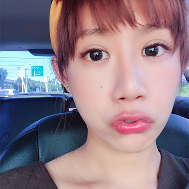 玻尿酸填補 玻尿酸豐臉 雅丰診所微整形案例angel 玻尿酸術後分享照四