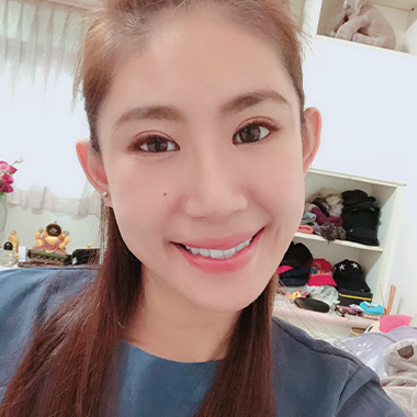 玻尿酸填補 玻尿酸豐臉 雅丰診所微整形案例angel 玻尿酸術後分享照三