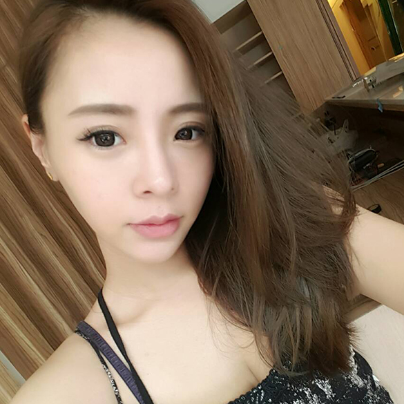 顴骨削骨 黃俊源醫師削骨 雅丰削骨案例寶咩 削骨術後照一