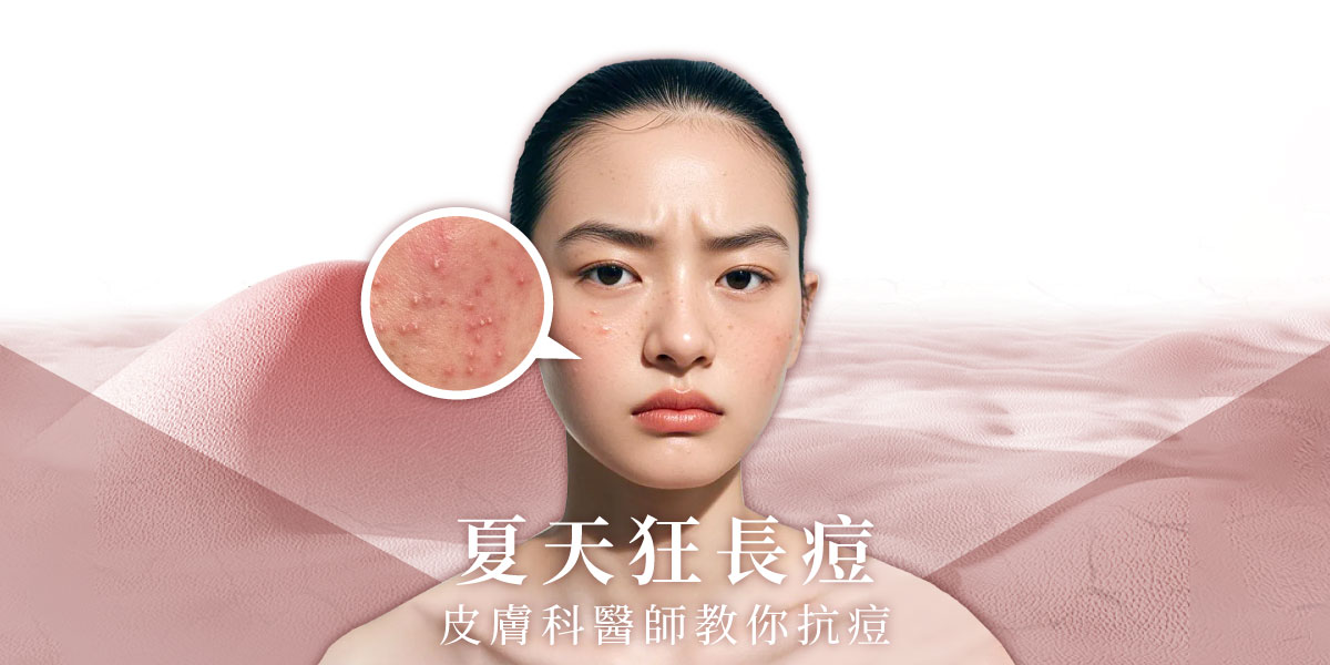 夏天狂長痘,皮膚科醫師教你抗痘!