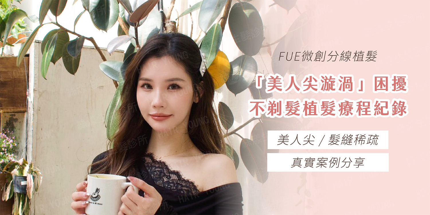 美人尖漩渦FUE不剃髮植髮_黃智威醫師