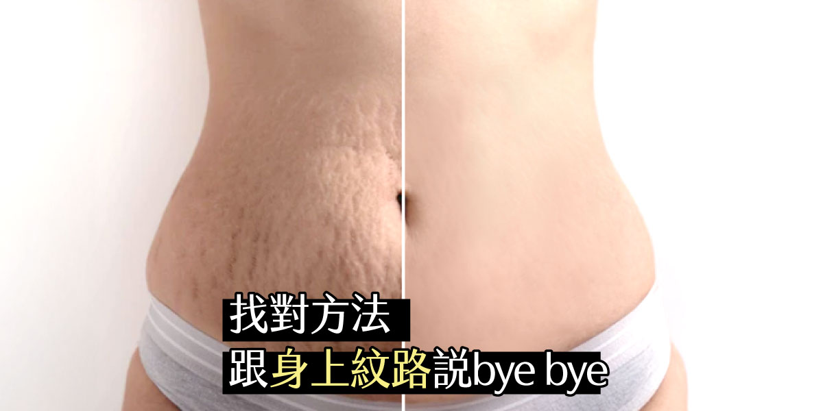 找對方法，跟身上紋路說bye bye 皮膚專科黃靜雯醫師│雅丰美膚診所