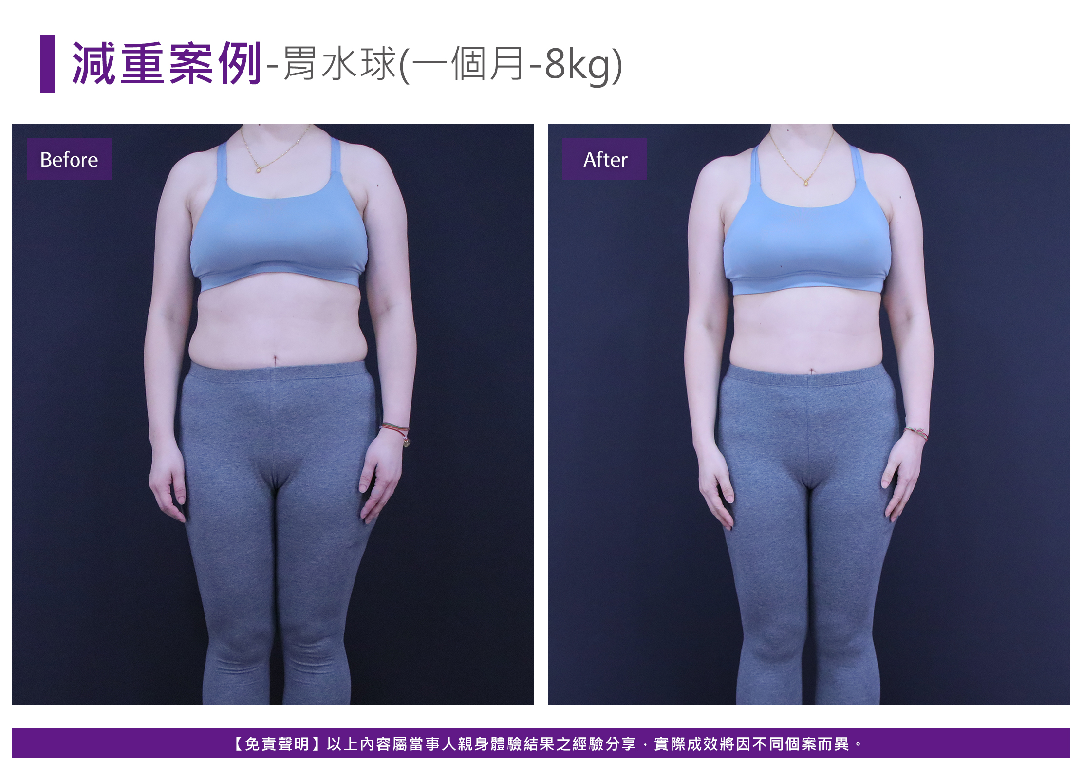 胃內水球案例