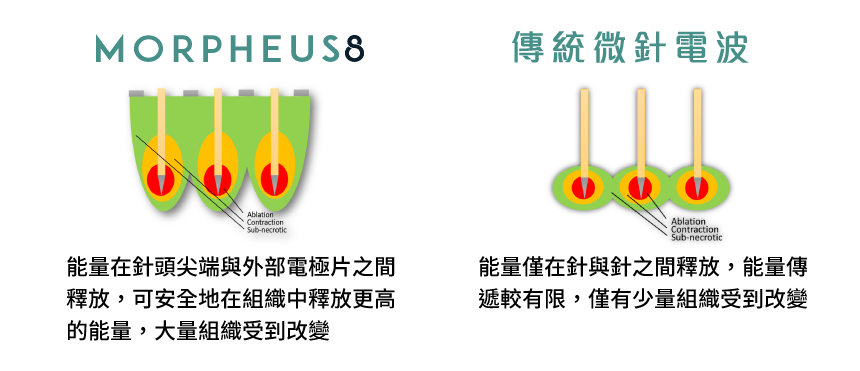 墨菲斯_優於傳統微針