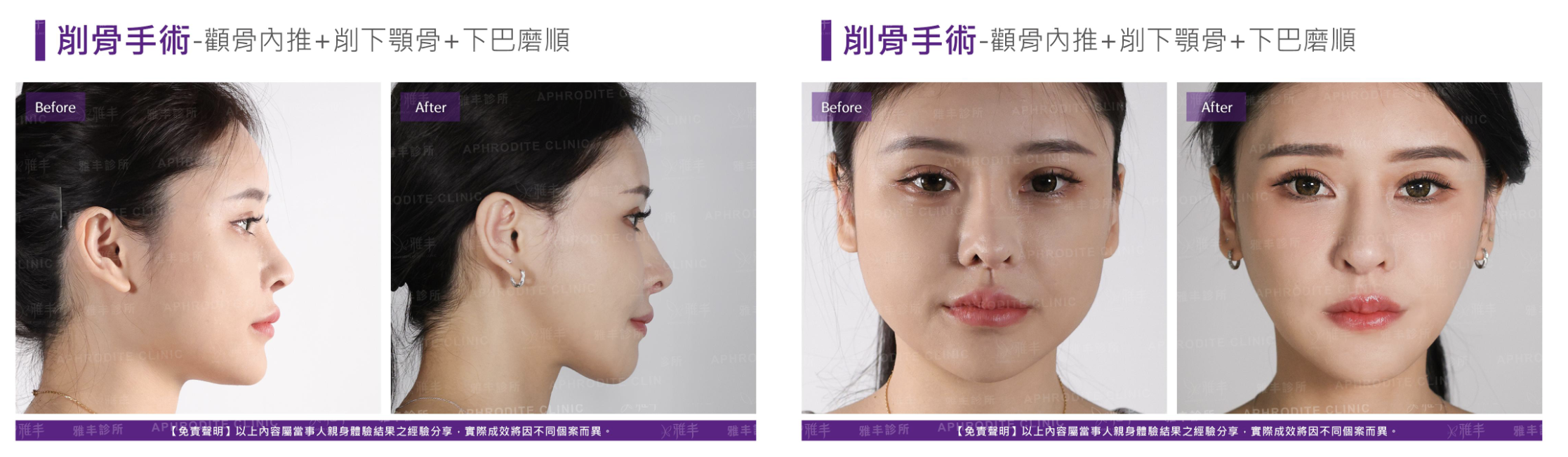 削骨手術_素人案例截圖