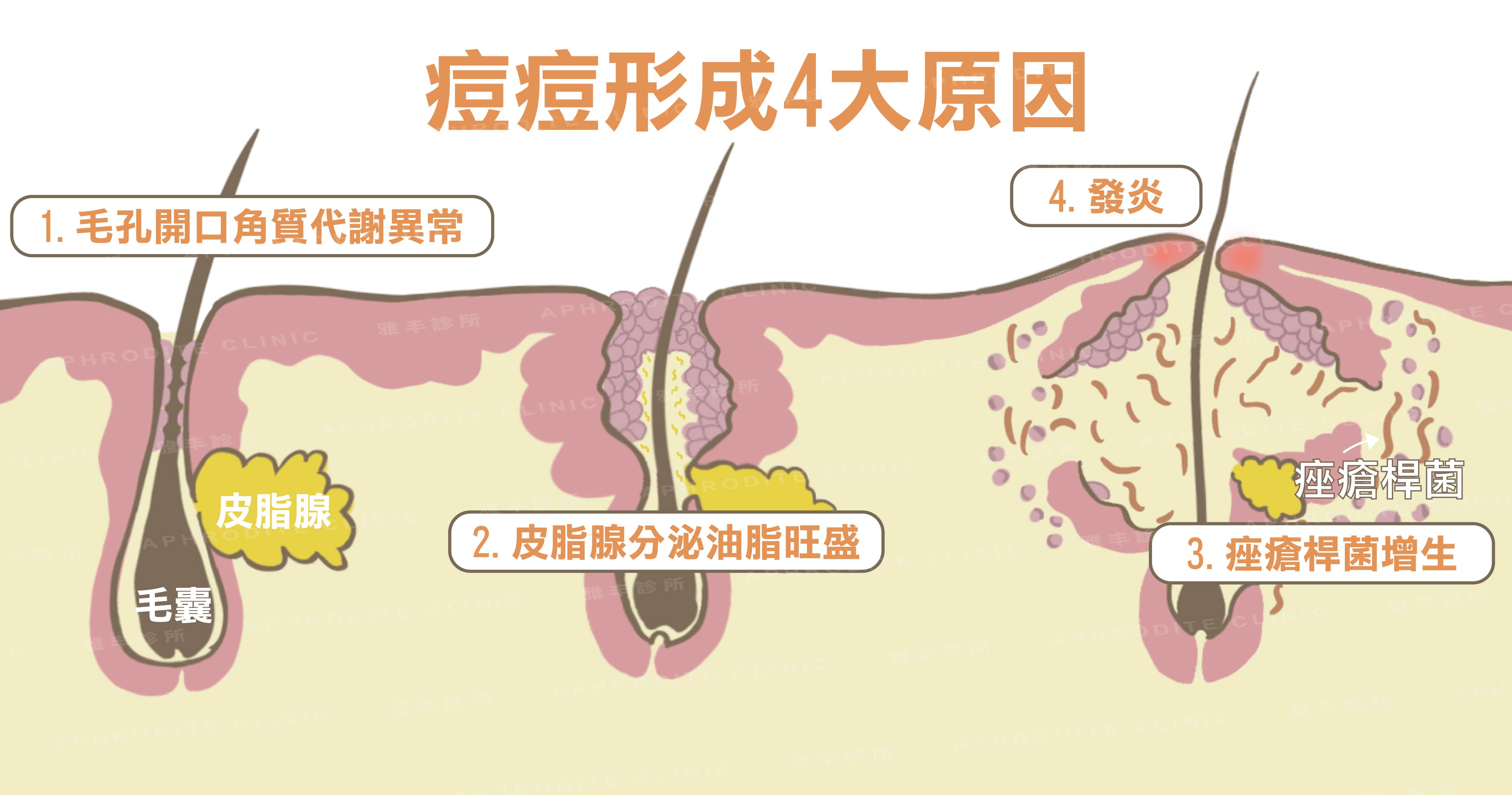 為什麼會長痘痘,長痘痘的原因,竹北皮膚科,陳威宇醫師