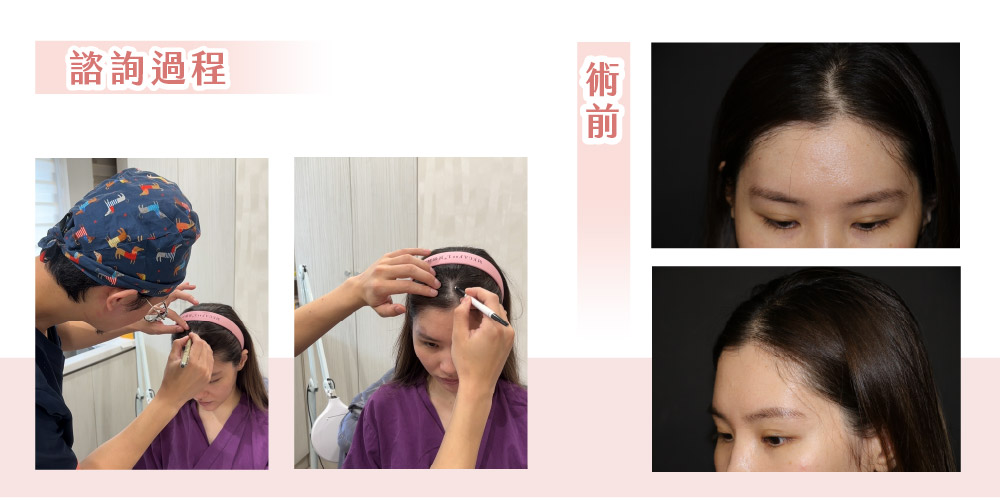 【FUE微創免剃髮】「美人尖禿頭、分線明顯」怎麼救！從髮縫明顯到髮量重生的改變_諮詢