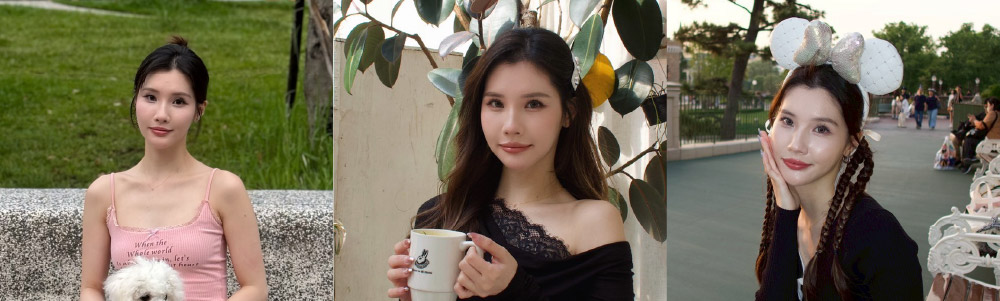 【FUE微創免剃髮】「美人尖禿頭、分線明顯」怎麼救！從髮縫明顯到髮量重生的改變_術後半年