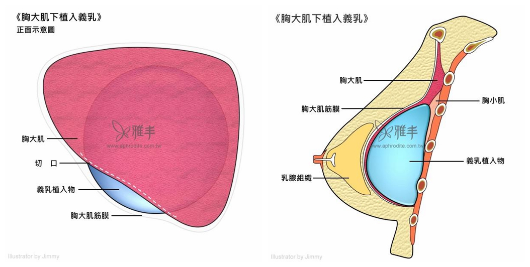 雅丰診所 DEPAAM 雙面複合式乳暈隆乳術