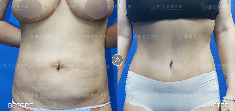 王冠穎醫師芭比腰案例2