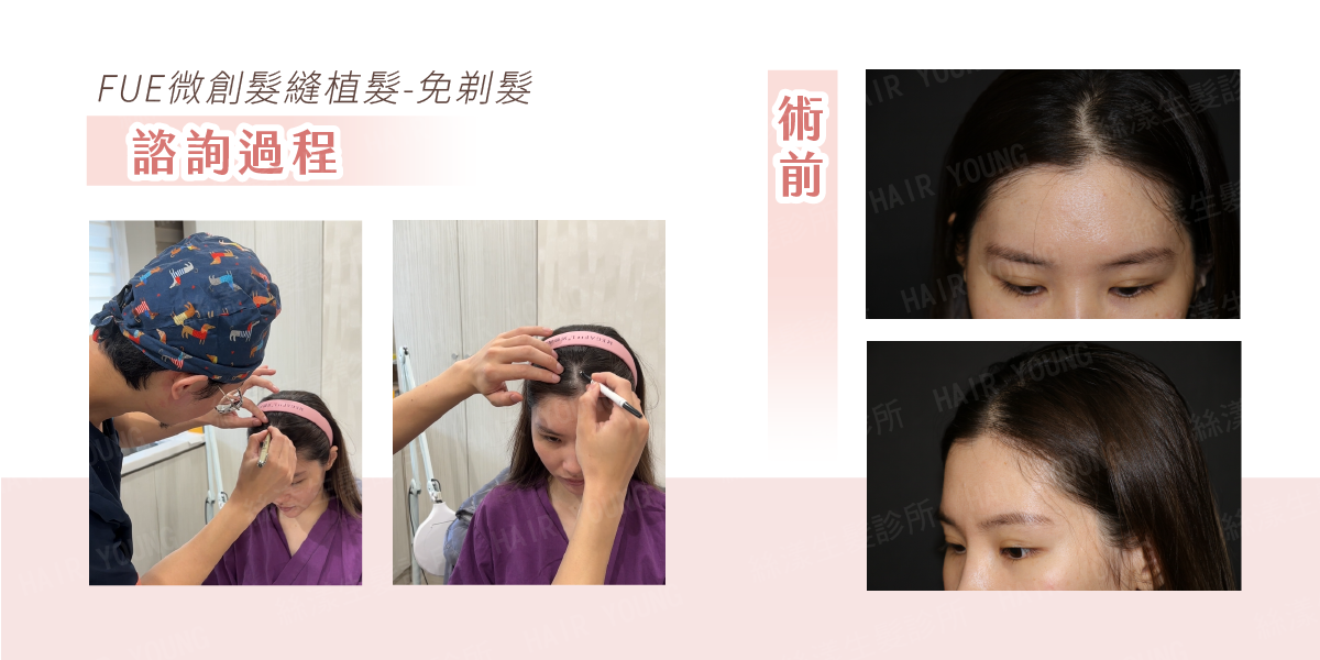 FUE微創髮縫植髮術前諮詢過程