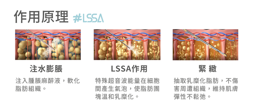 雅丰服務項目_LSSA音浪脂雕_作用原理