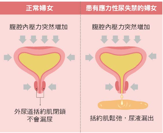 尿失禁