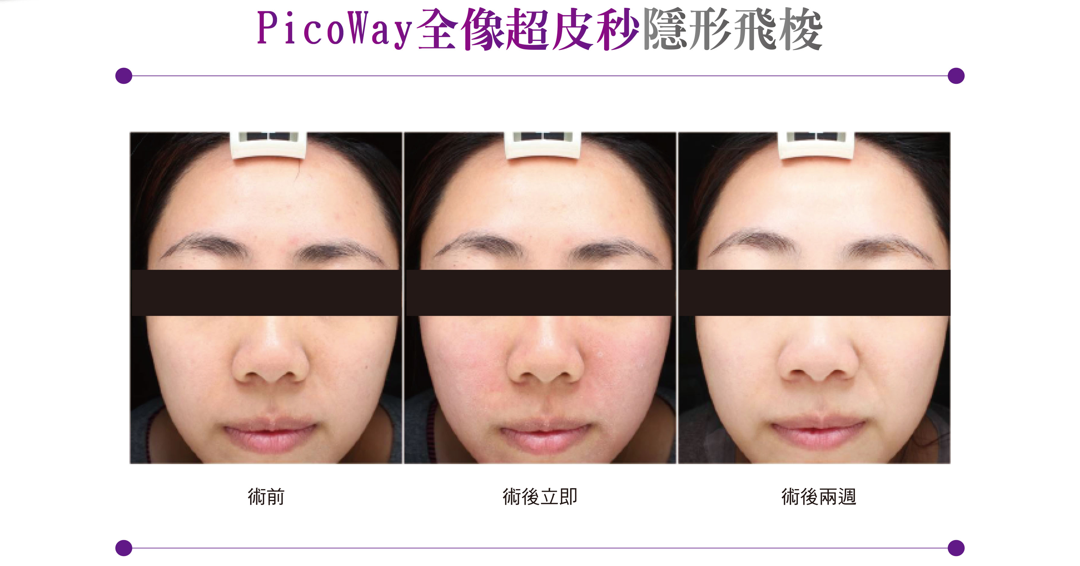 美國原廠PicoWay皮秒雷射10