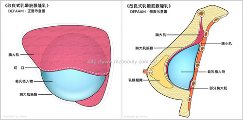 隆乳手術圖解,雅丰診所