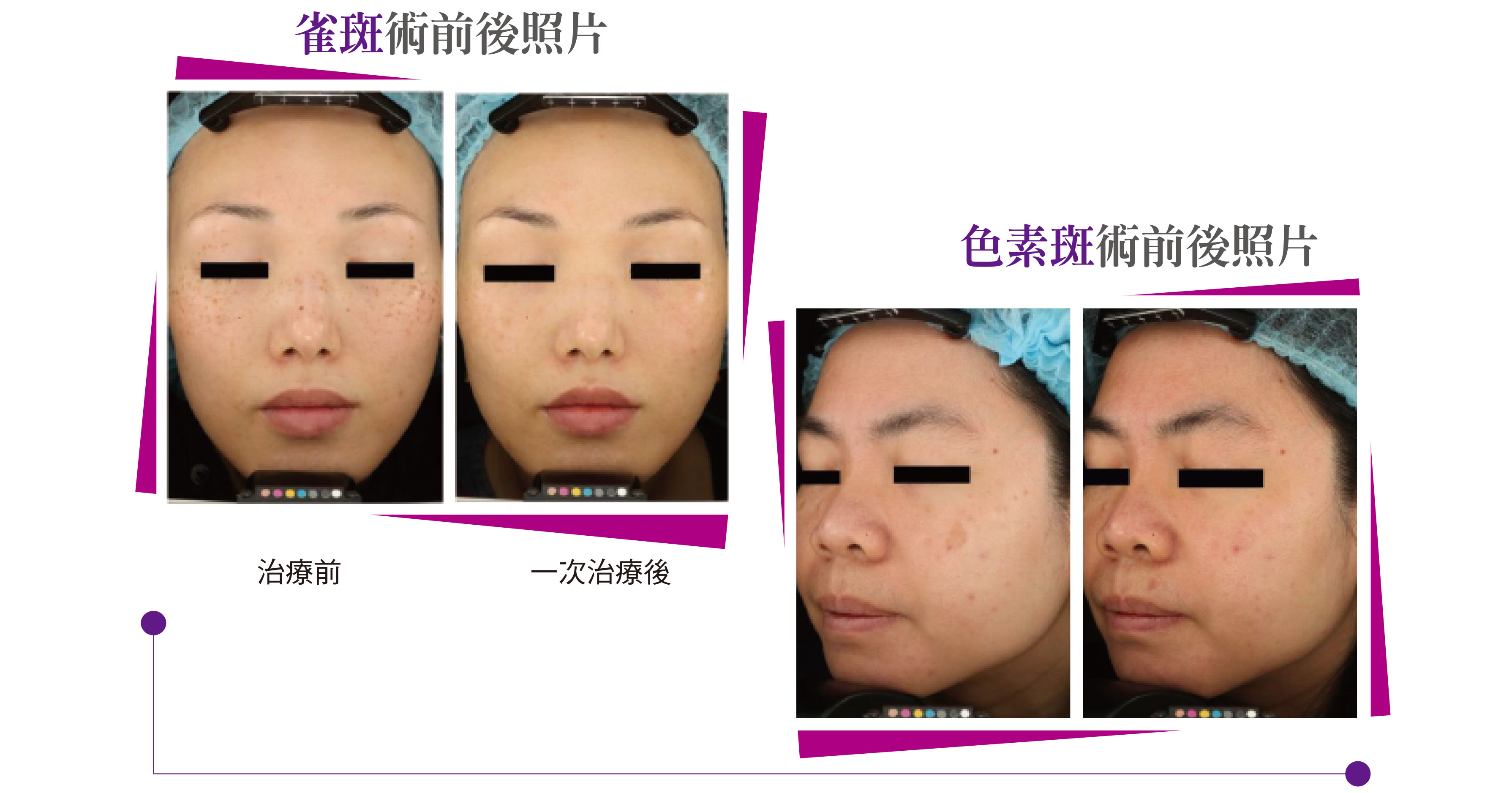美國原廠PicoWay皮秒雷射12