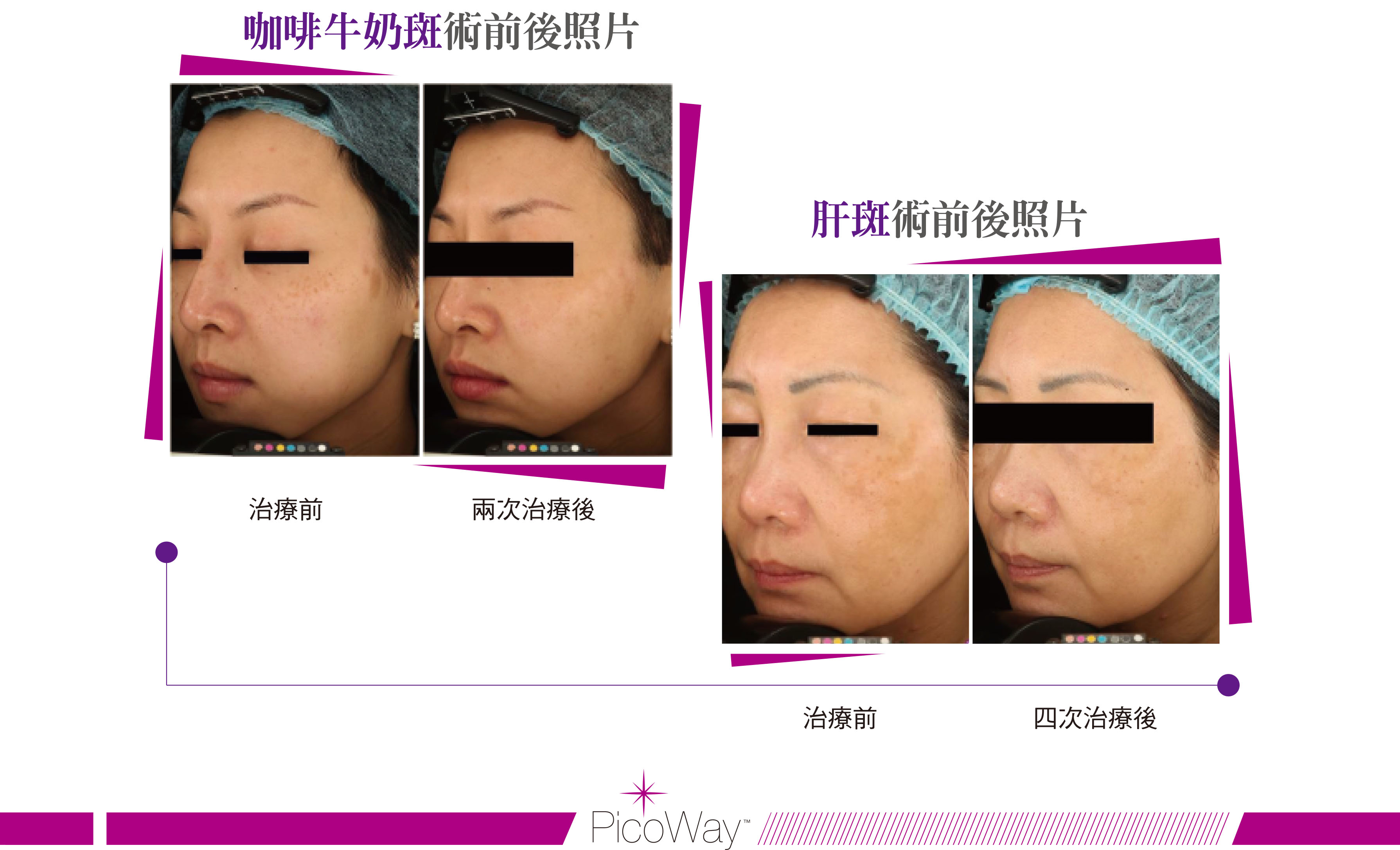美國原廠PicoWay皮秒雷射13