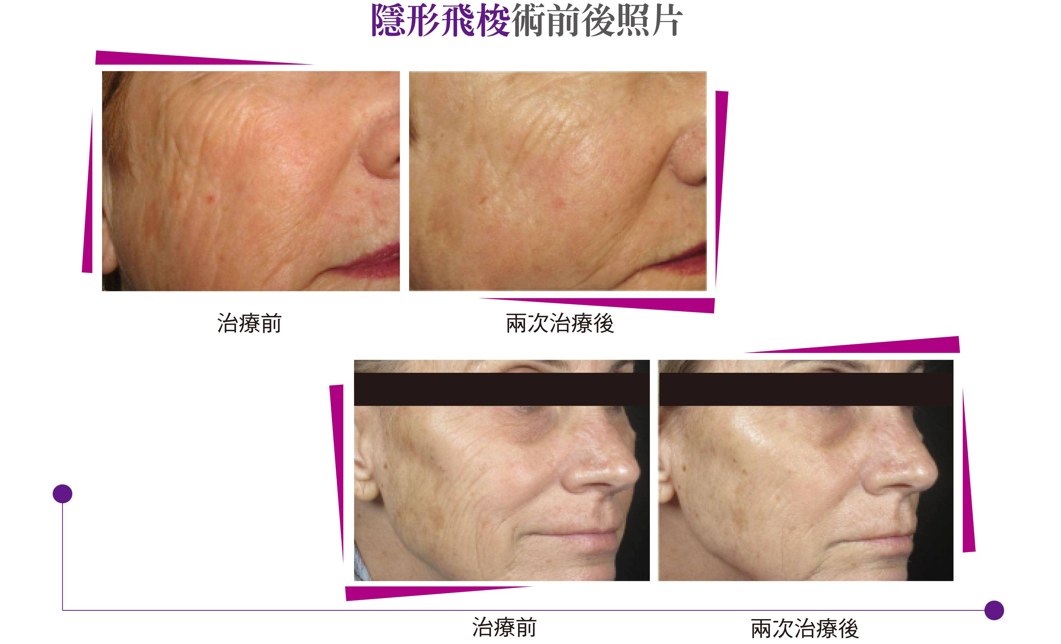 美國原廠PicoWay皮秒雷射14