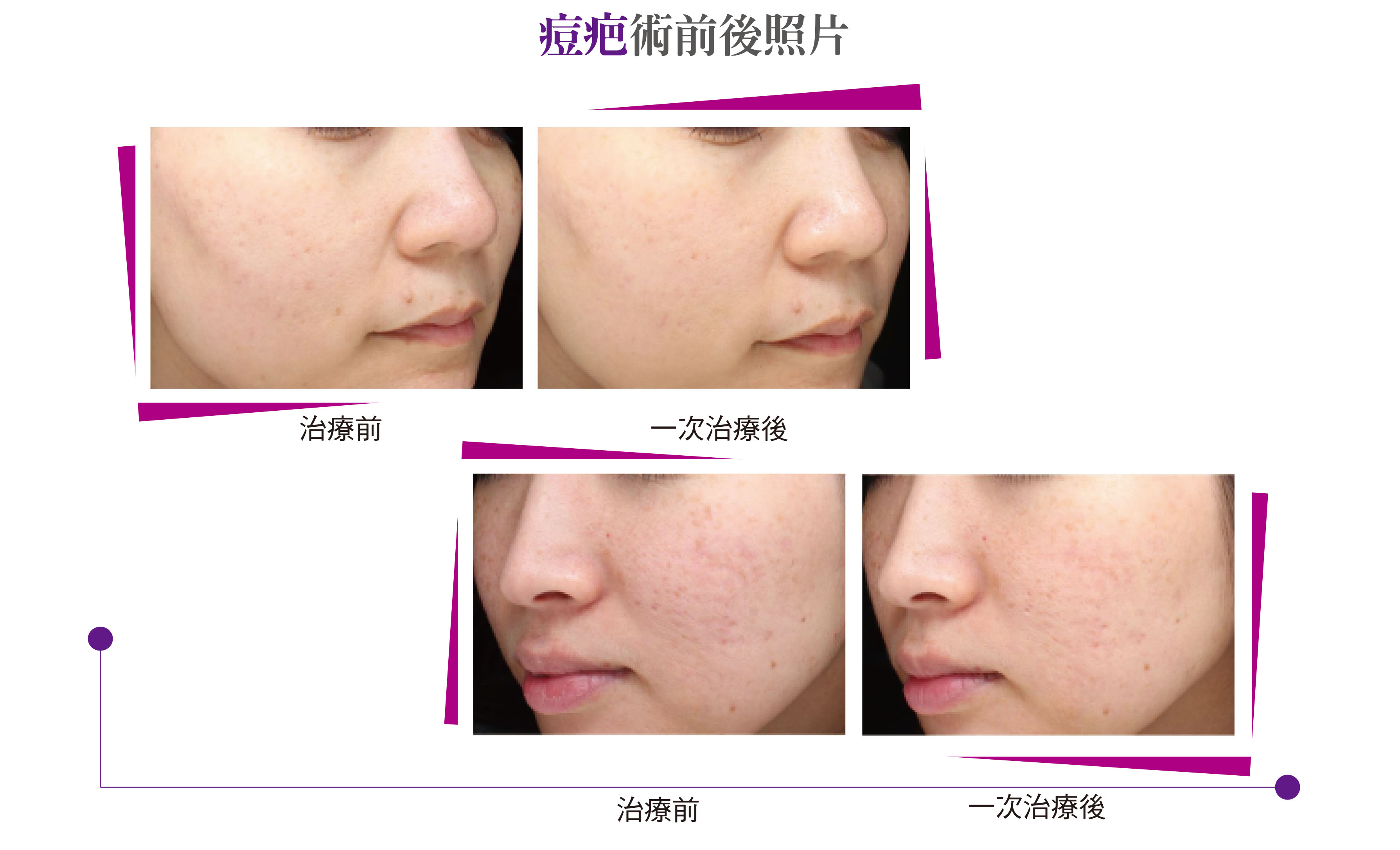 美國原廠PicoWay皮秒雷射15