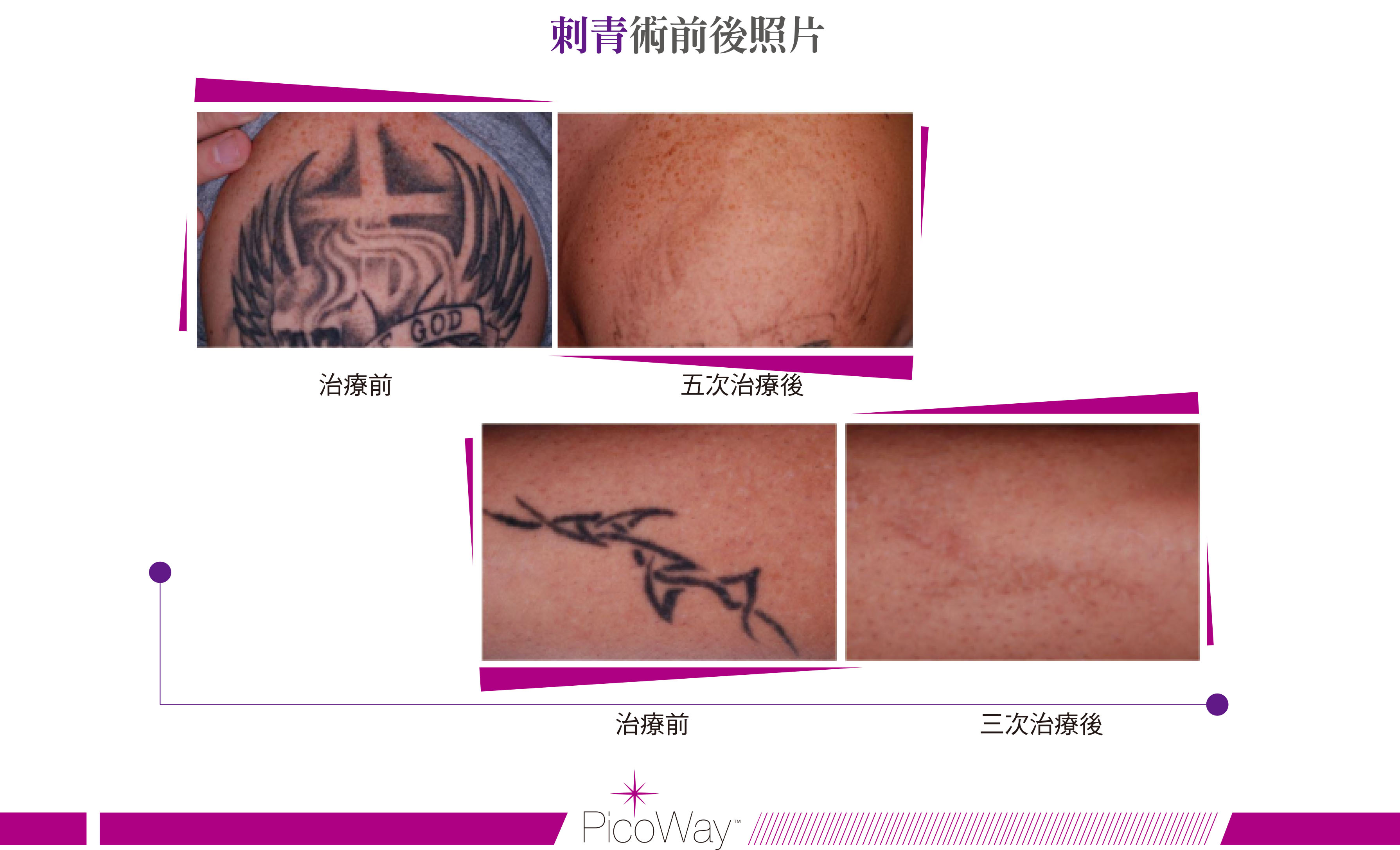 美國原廠PicoWay皮秒雷射16