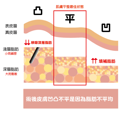 抽脂重修手術介紹 | 雅丰席睿診所余宗宸院長