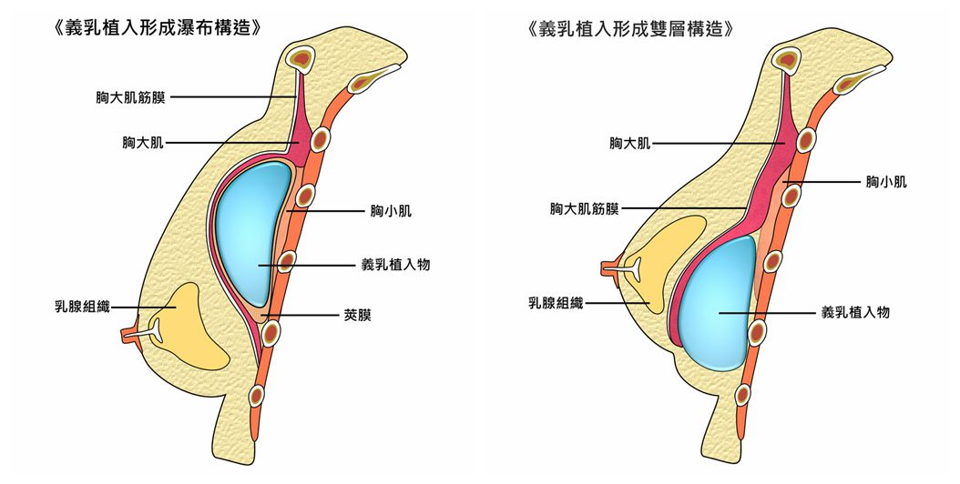 雙層奶布袋奶隆乳失敗