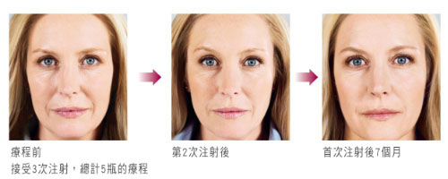 雅丰診所 舒顏萃3D聚左旋乳酸 童顏針