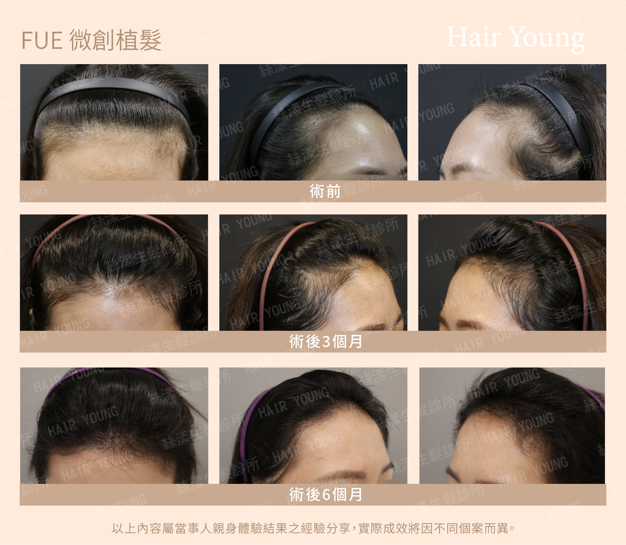 FUE 微創植髮案例1629根