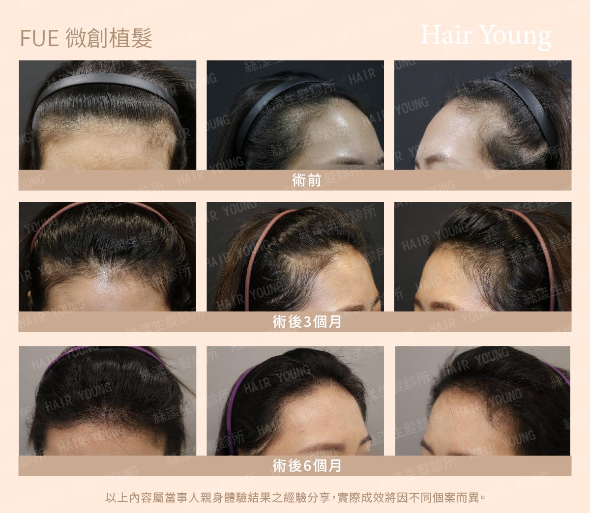 FUE 微創植髮 1629根