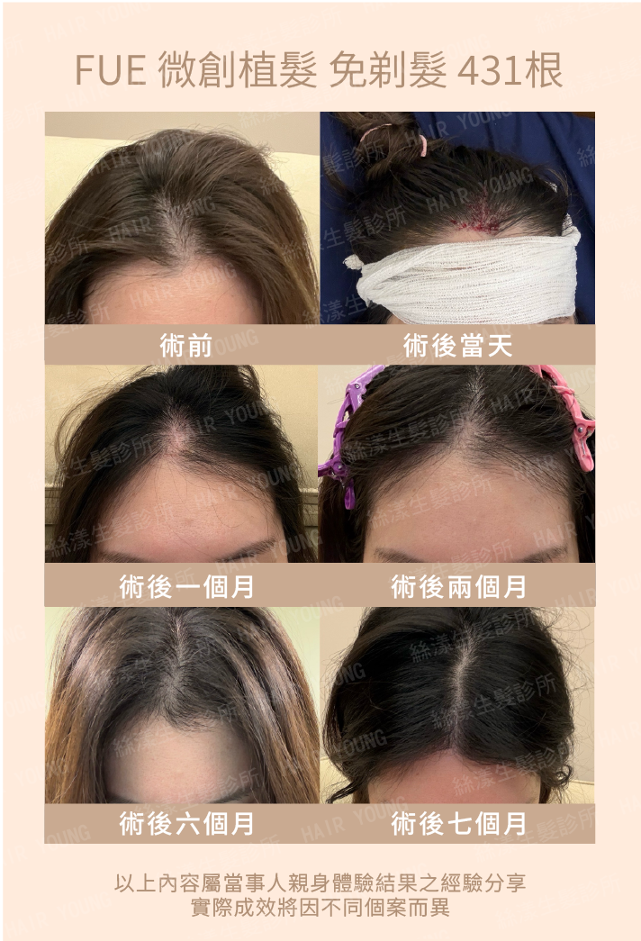 FUE微創植髮免剃髮431根