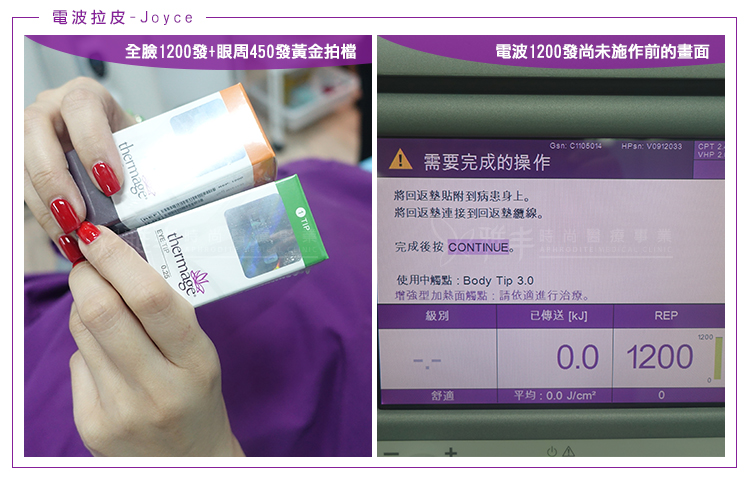 電波拉皮1200發+眼周電波450發