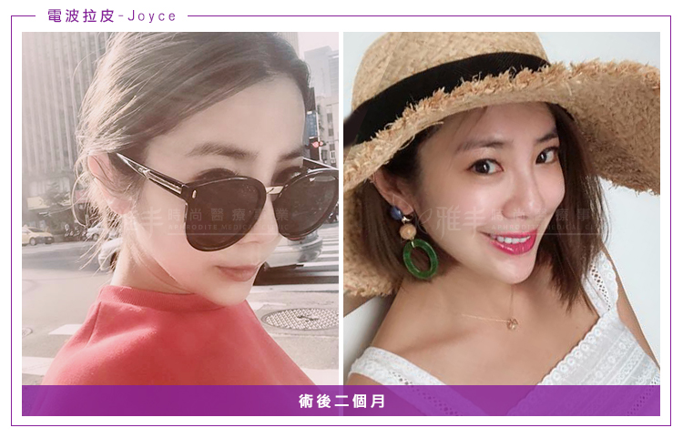 電波拉皮Joyce術後二個月,生活照比對