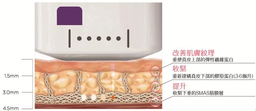 Utims沃緹音波拉皮-施打於肌膚作用圖