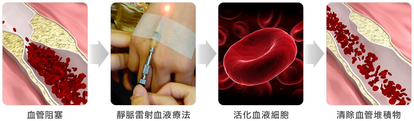 氦氖靜脈雷射療程作用