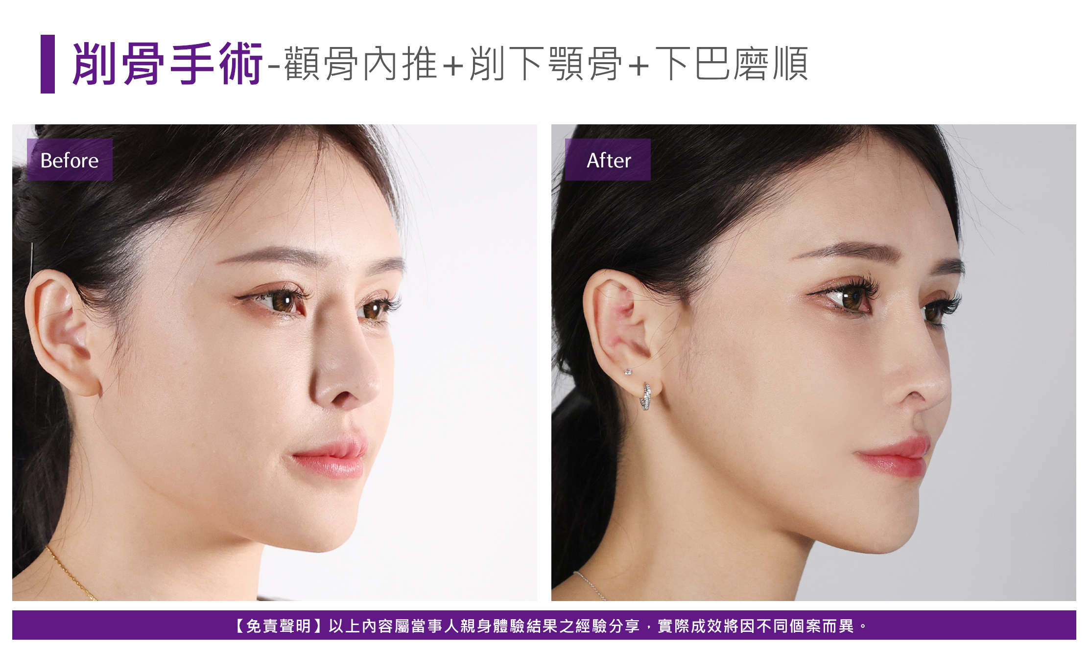 第三代削骨