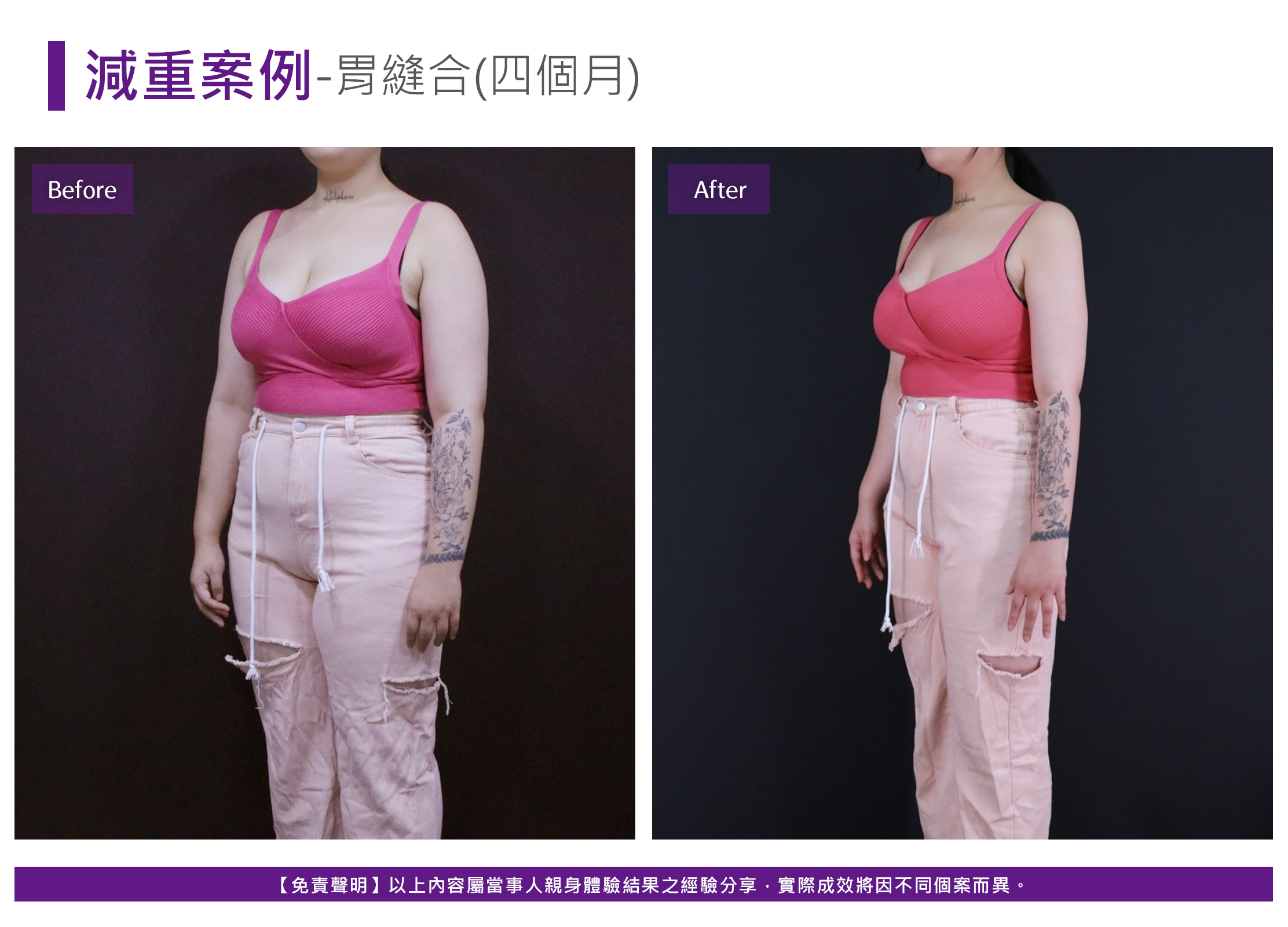 減重案例-胃縫合