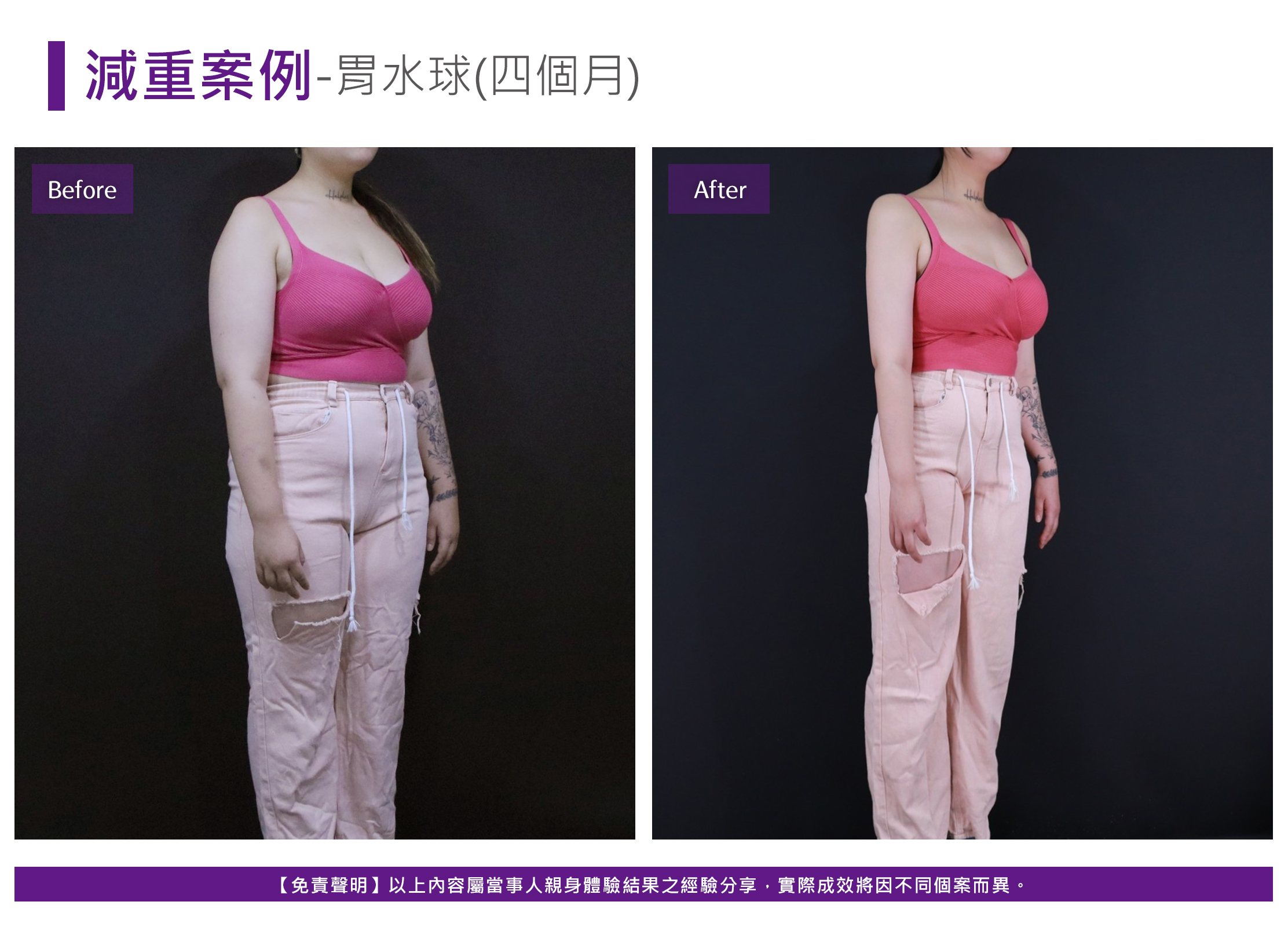 減重案例-胃縫合