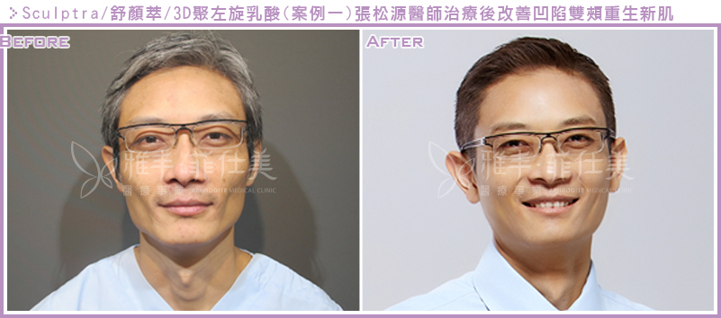 Sculptra 舒顏萃 3D聚左旋乳酸 人氣見證-張松源醫師