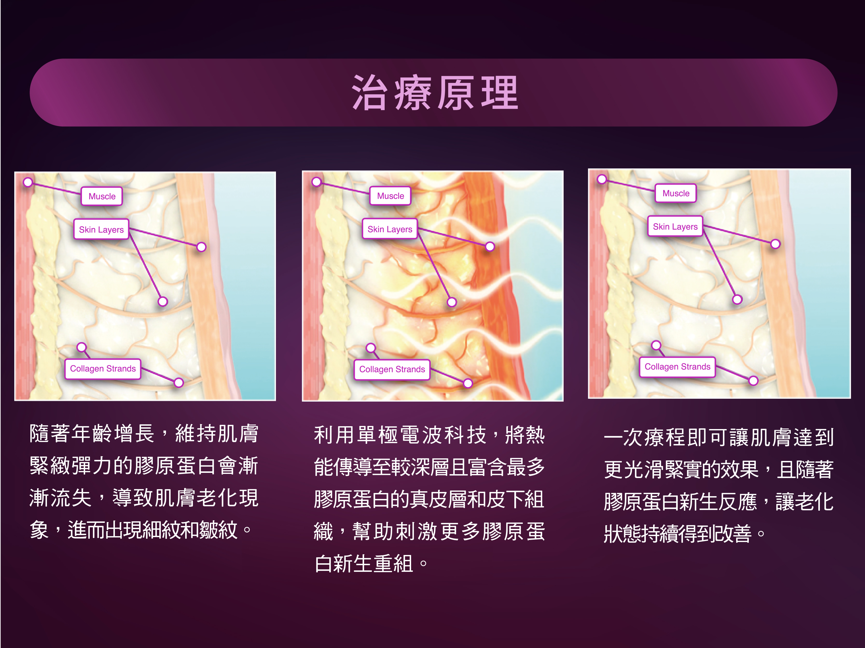 雅豐-新一代Thermage FLX鳳凰電波治療原理