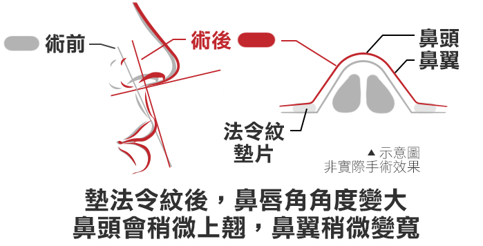 法令紋手術後遺症,法令紋墊片