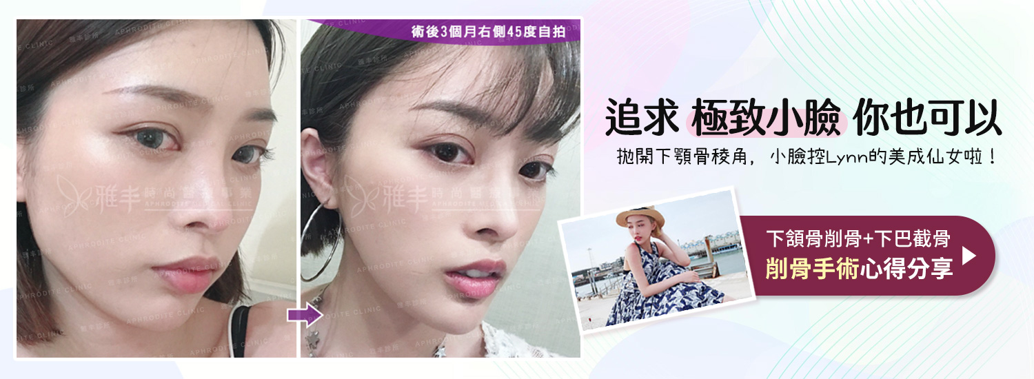 banner_術後3個月_Lynn 的瓜子臉蛻變