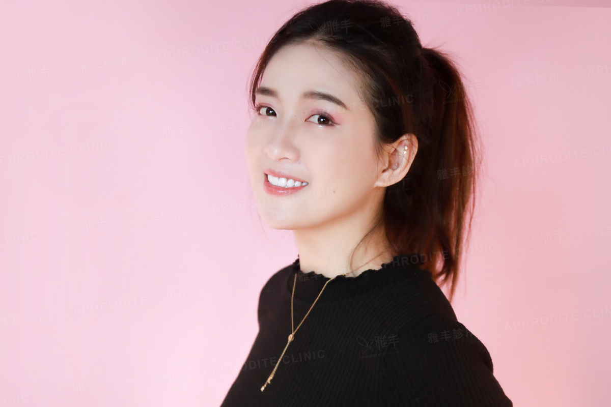 眼袋手術 抽脂補臉 雅丰診所案例小思 王子杰醫師
