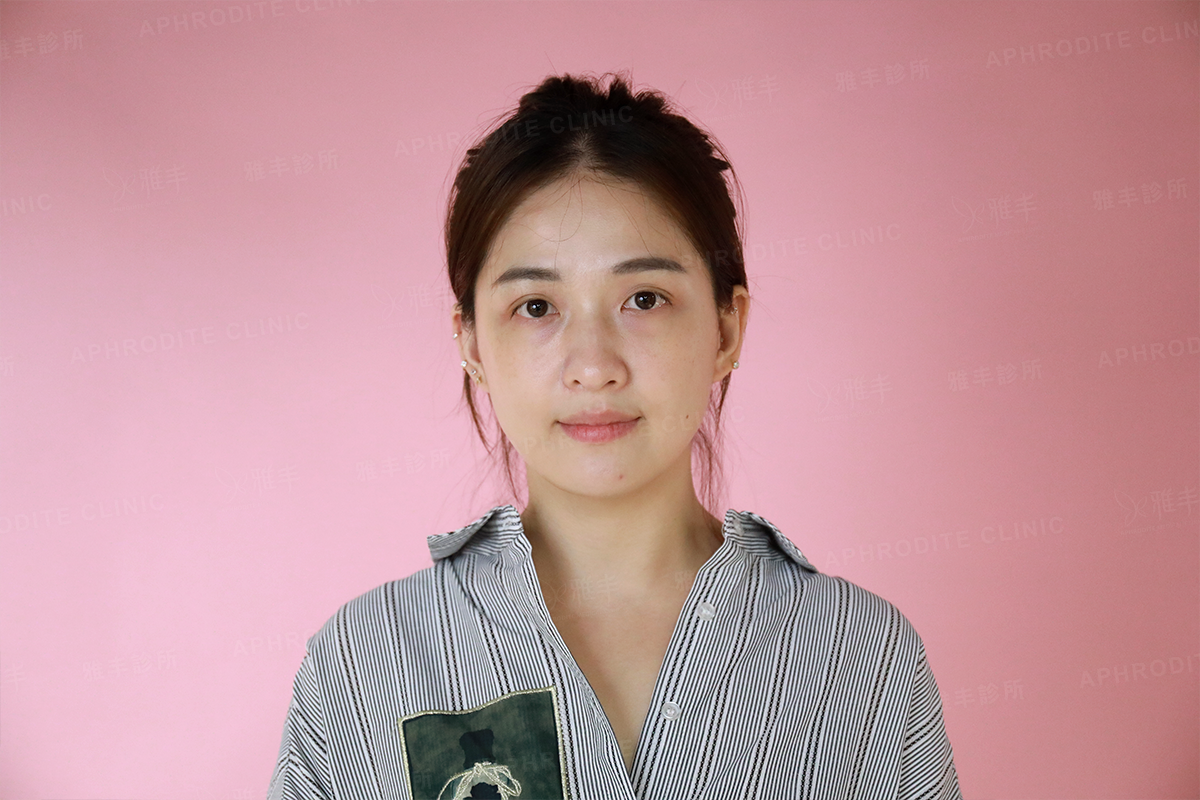 眼袋手術 抽脂補臉 王子杰醫師 雅丰診所案例小思 術前困擾