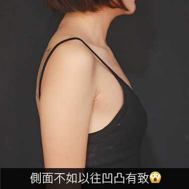 魔滴隆乳 Motiva隆乳 雅丰案例 貝露莎 困擾二