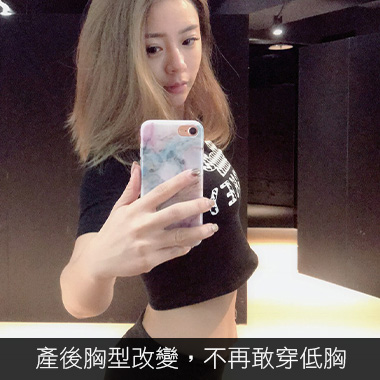 魔滴隆乳 Motiva隆乳 雅丰案例 寶咩 術前困擾二