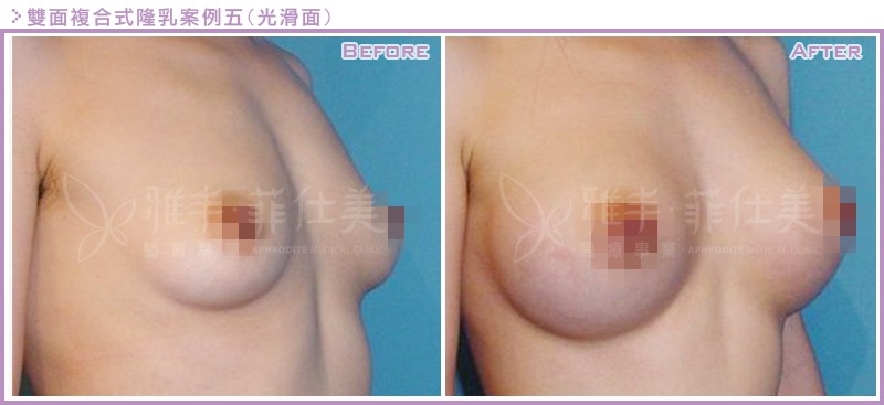 雙面複合式隆乳案例5